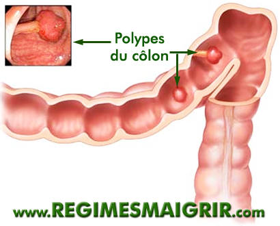 Avoir les polypes n'est pas toujours synonyme de cancer colorectal mais il convient de les soigner rapidement