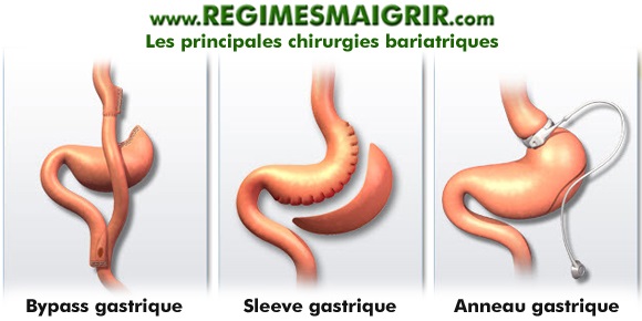 Les 3 principaux types de bariatrie