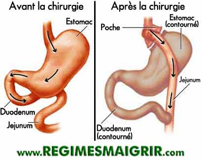 Vue sur l'estomac et l'intestin, avant et après l'opération du bypass gastrique