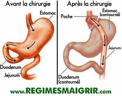 Vue sur l'estomac et l'intestin, avant et aprs l'opration du bypass gastrique