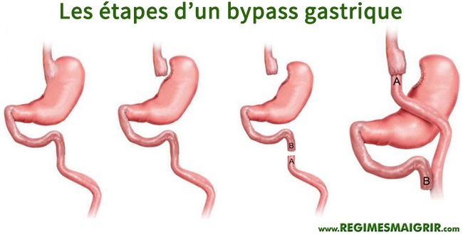 Les principales phases d'une opration de bypass gastrique