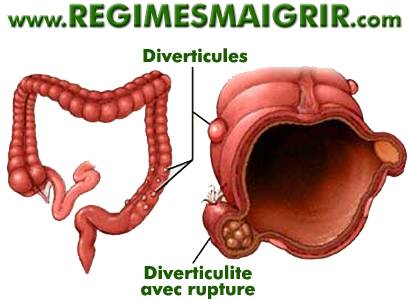 Diverticulose avec diverticulite