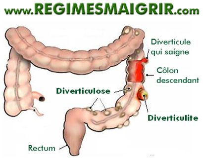 Diverticulite : aliments à manger et à éviter