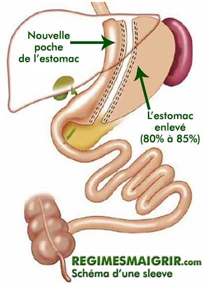 Schma d'une sleeve gastrique