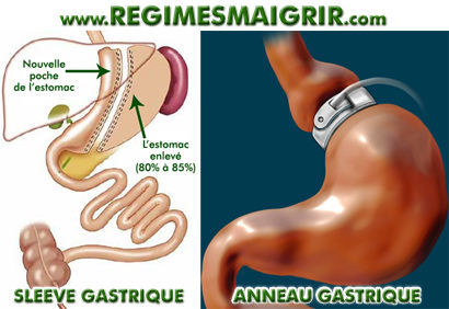 Gastroplastie