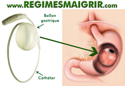 Schma de pose du ballon gastrique