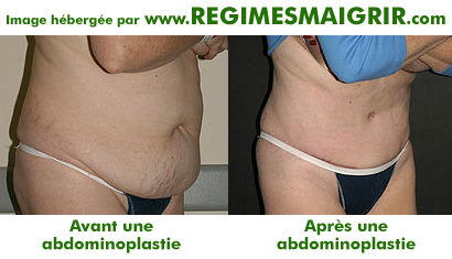 Avant et aprs une opration chirurgicale d'abdominoplastie