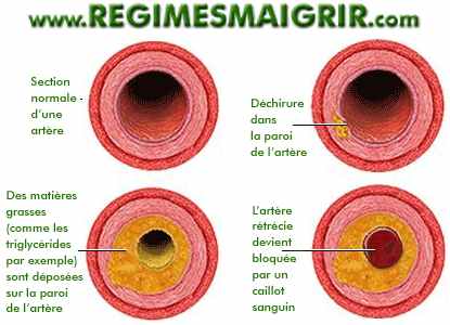 Artre bouche par triglycrides ou autres matires grasses