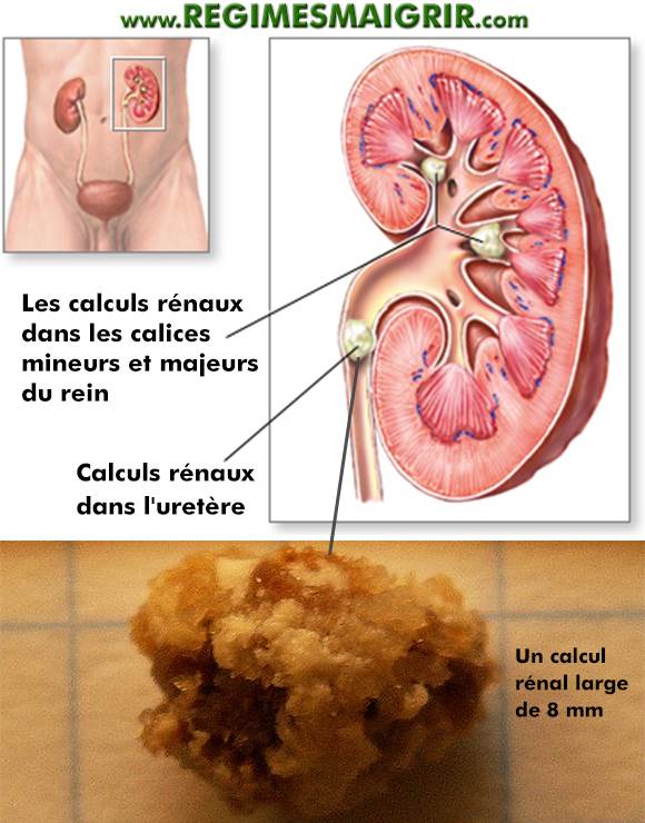 Des calculs rnaux sont montrs ici  l'intrieur du rein par un dessin