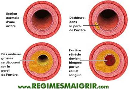 Rtrcissement des artres  cause du cholestrol