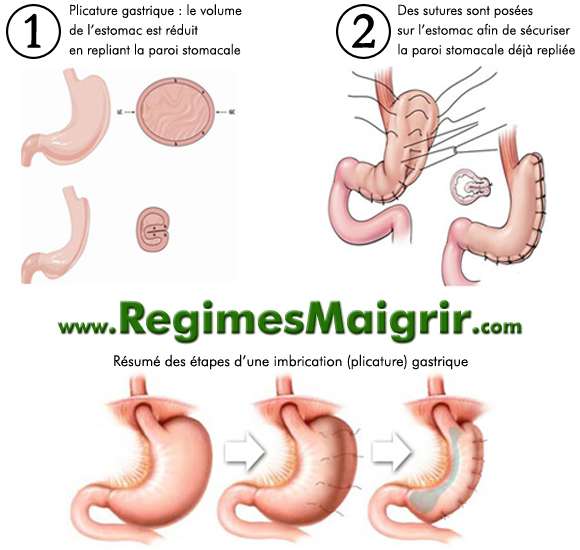 Schma expliquant le droulement d'une imbrication (plicature) gastrique