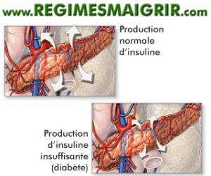 Une production d'insuline insuffisante survient chez les patients diabtiques