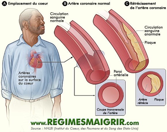 Schéma expliquant la différence entre une artère normale et une autre rétrécie par les plaques
