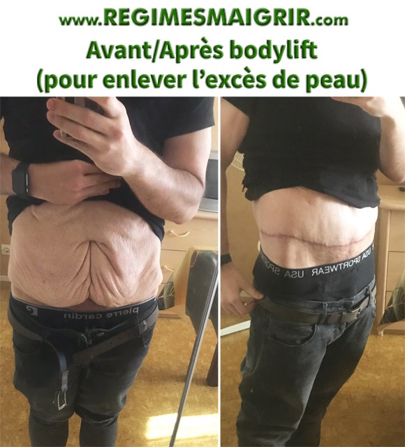 Mickael a subi un bodylift afin d'enlever l'excs de peau aprs son rgime