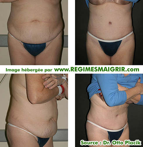 Avant aprs une abdominoplastie