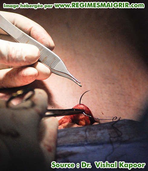 Suturer l'incision aprs avoir fini l'abdominoplastie